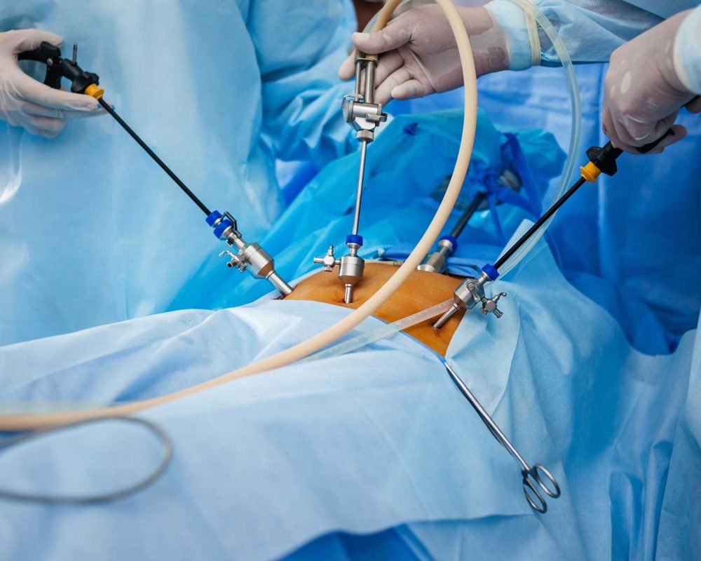 Laparoscopy Surgery